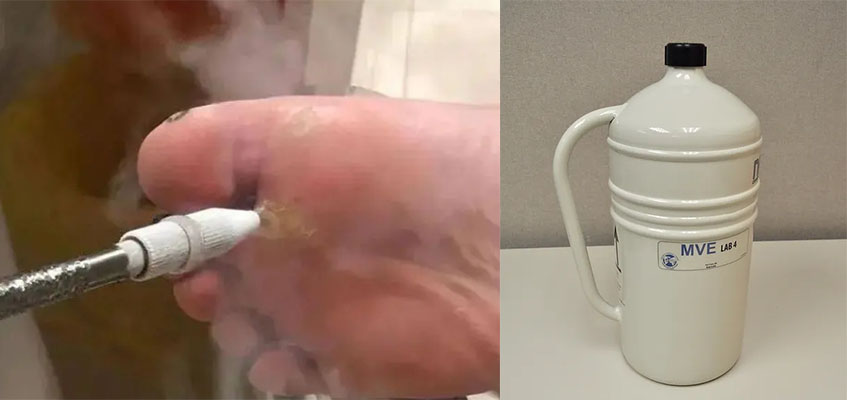 液氮治療 液氮治療